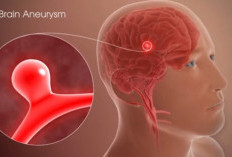 Hati-hati! Aneurisma, Penipisan Pembuluh Darah Otak Penyebab Stroke