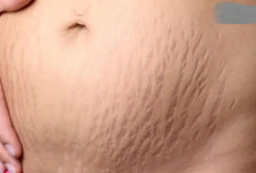 Ketahui! Penyebab dan Cara Mencegah Stretch Mark